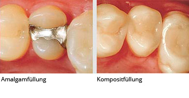 Kompositfüllung: Infos zur Zahnfüllung aus Kunststoff